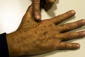 dezembro-laranja-promove-dia-de-atendimento-gratuito-para-diagnostico-precoce-do-cancer-de-pele-em-belem