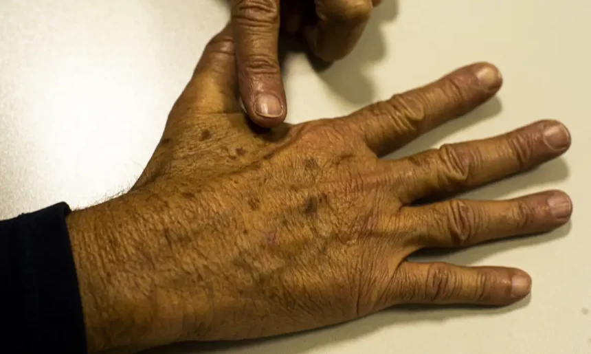 dezembro-laranja-promove-dia-de-atendimento-gratuito-para-diagnostico-precoce-do-cancer-de-pele-em-belem